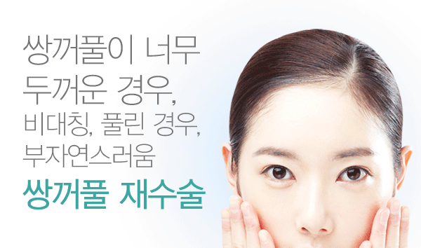 쌍커풀매몰법