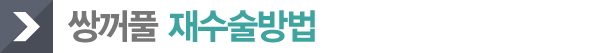 쌍커풀 재수술방법
